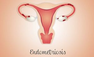 endometriosis